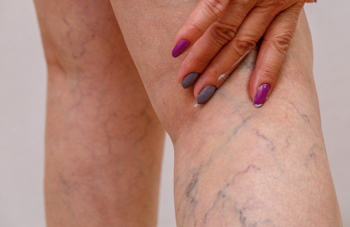 Escleroterapia